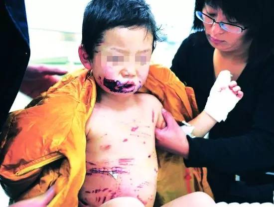 小伤口没发现,4岁男孩突然狂躁而死!这种病正