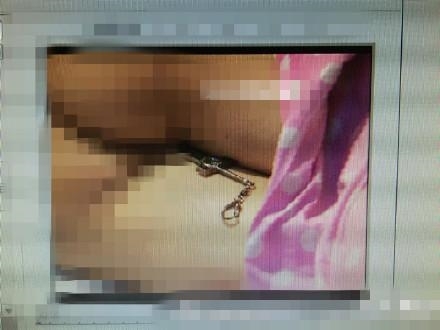 中年男子拿刀插向自己屁股是因为痔疮?医生:没痔疮_新蓝网