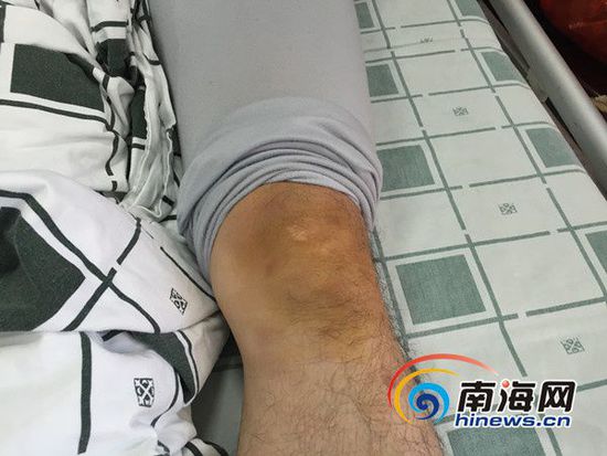 蔡於庆左侧膝盖受伤。南海网记者高鹏摄