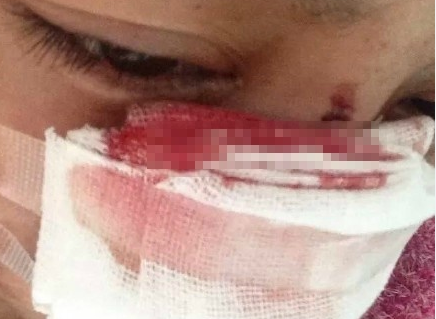 温州一女子结婚8年长期遭受家暴 丈夫竟割掉了她的鼻子!