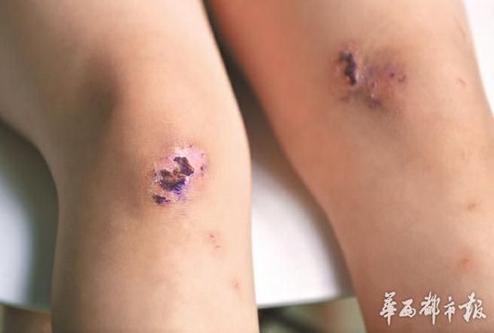 雯雯的两个膝盖上，都留有伤疤。