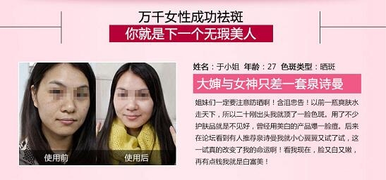 怎样美白去斑效果好 安全有效的去除雀斑的方法