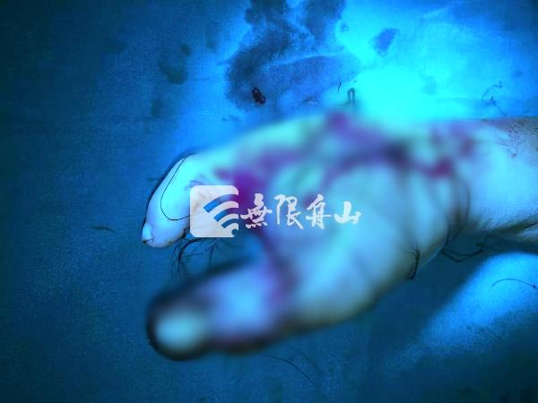 女子右手被压成“肉饼” 医生用脚趾再造手指