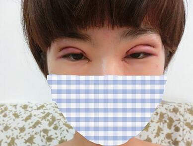 埋线双眼皮失败 嘉兴时髦女孩半边脸肿得像桃