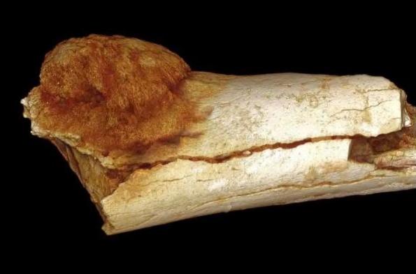 美媒：古人类化石惊现恶性肿瘤 系最早癌症证据
