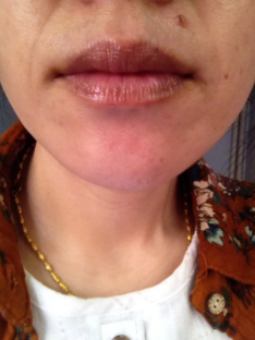 唇炎的症状有哪些?怎么根除严重唇炎?