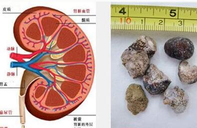 拒绝手术 男子每天喝10瓶啤酒想要化掉肾结石