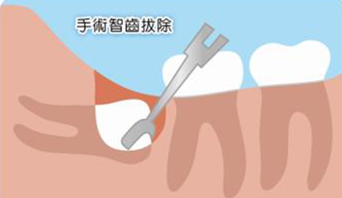 拔智齿前 这些事项千万要注意!