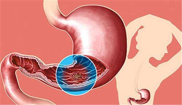 你知道胃酸过多的危害吗?胃部健康需要受到重视
