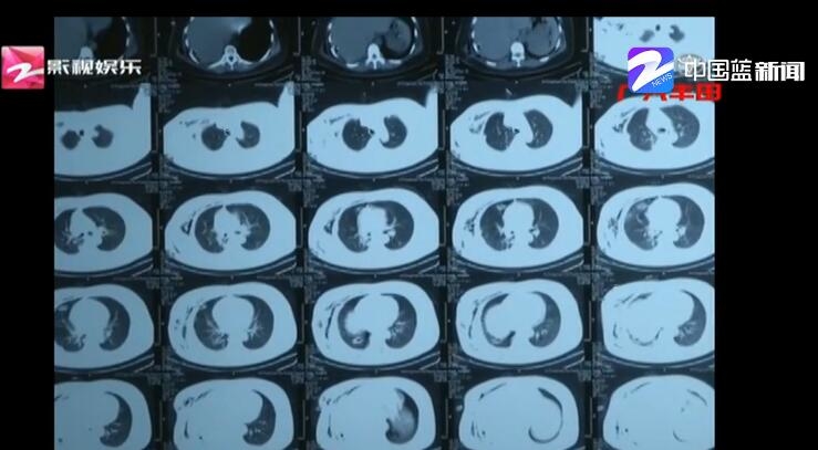 肺部感染六年 迟迟不见好?原来肺叶上藏了个小辣椒图片