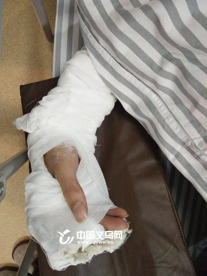 记者在中心医院见到了负伤的余卓霖,医生诊断为右手屈肌腱断裂,刚刚