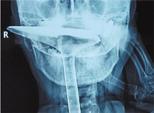 绍兴66岁大爷拿锅铲捅喉止痒 拔不出来被送医