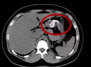 杭州16岁男孩肚子痛 CT片吓坏众人:胃里一堆