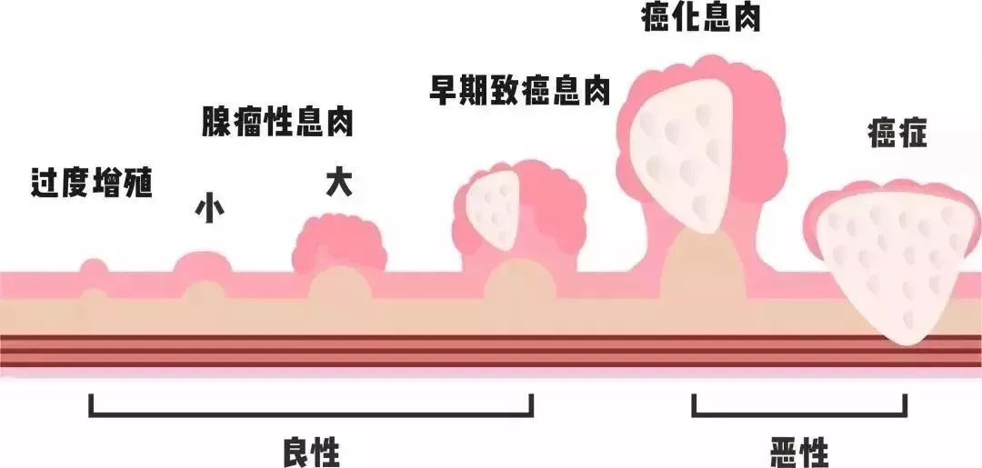 息肉和癌竟然是"近亲?警惕5种危险信号,小心癌变!