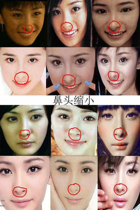 现在鼻子有很明显的变化,以前的鼻头过于的尖而突出,甚至有点鹰钩鼻