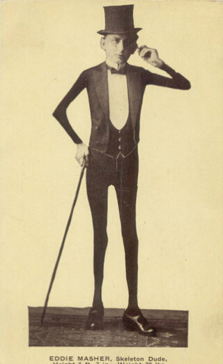 重庆:8岁女孩长15根脚趾12根手指每天为穿鞋发愁