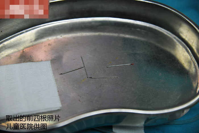 聊城被扎针女婴钢针全部取出 10根注射针头2根缝衣针