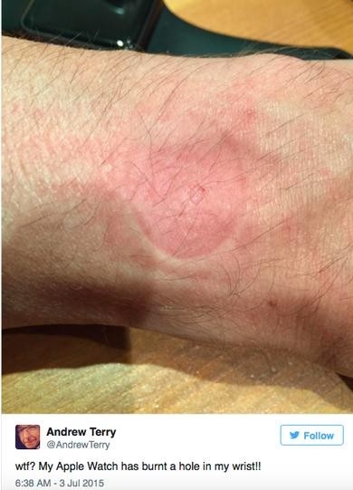 applewatch存过热隐患佩带一小时灼伤起水泡