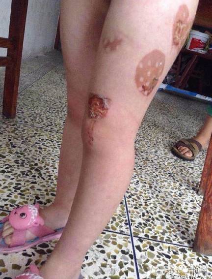 四岁女童被"烙刑"下手的竟是亲生父亲!