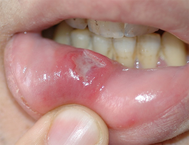 舌头两侧溃疡舌癌图片