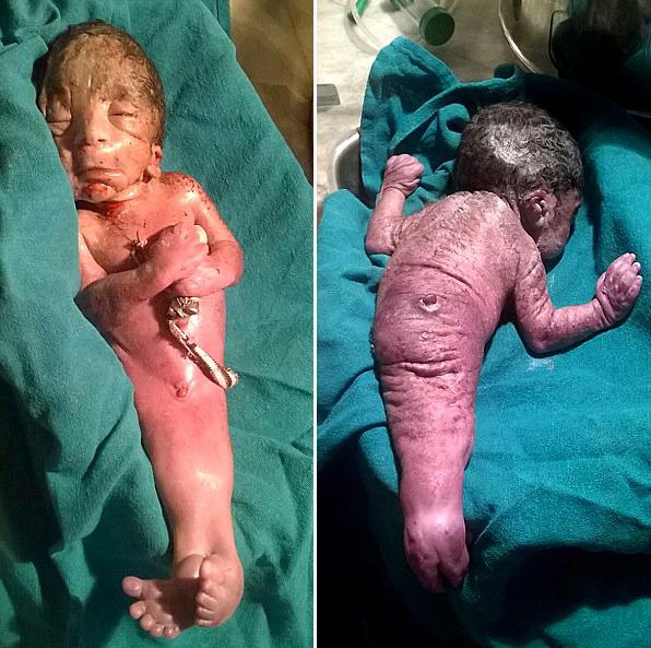 印度新生儿患美人鱼综合症 仅存活约10分钟