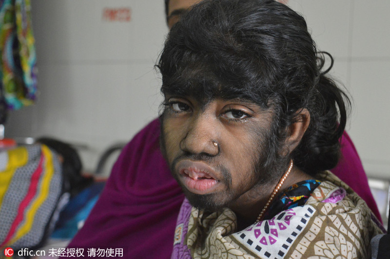 震惊!孟加拉女孩全身毛发疯长似狼孩