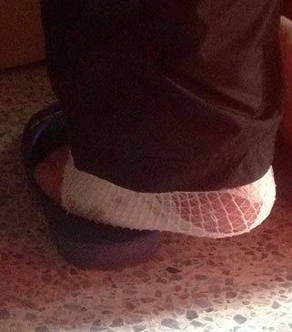 广州一大学生长期抖腿把脚抖成骨折