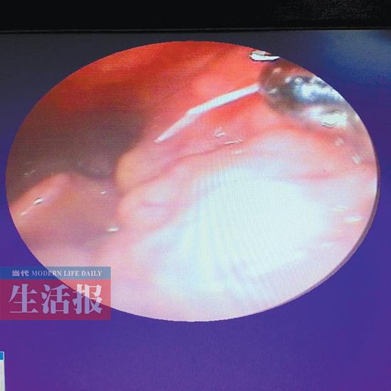 鱼刺卡在姐姐咽喉内左侧扁桃体下方