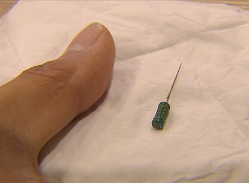 孩子补牙 扩大针误吞进肚子 医生很抱歉 妈妈很抓狂