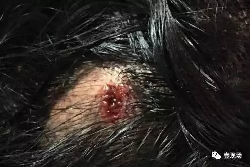 王女士头部被砸出一个小血洞