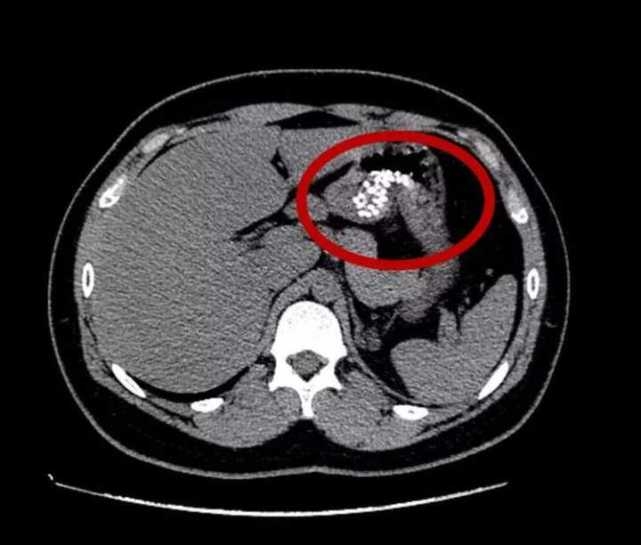 胃部ct片里一堆白点点16岁男孩吃下一大把药