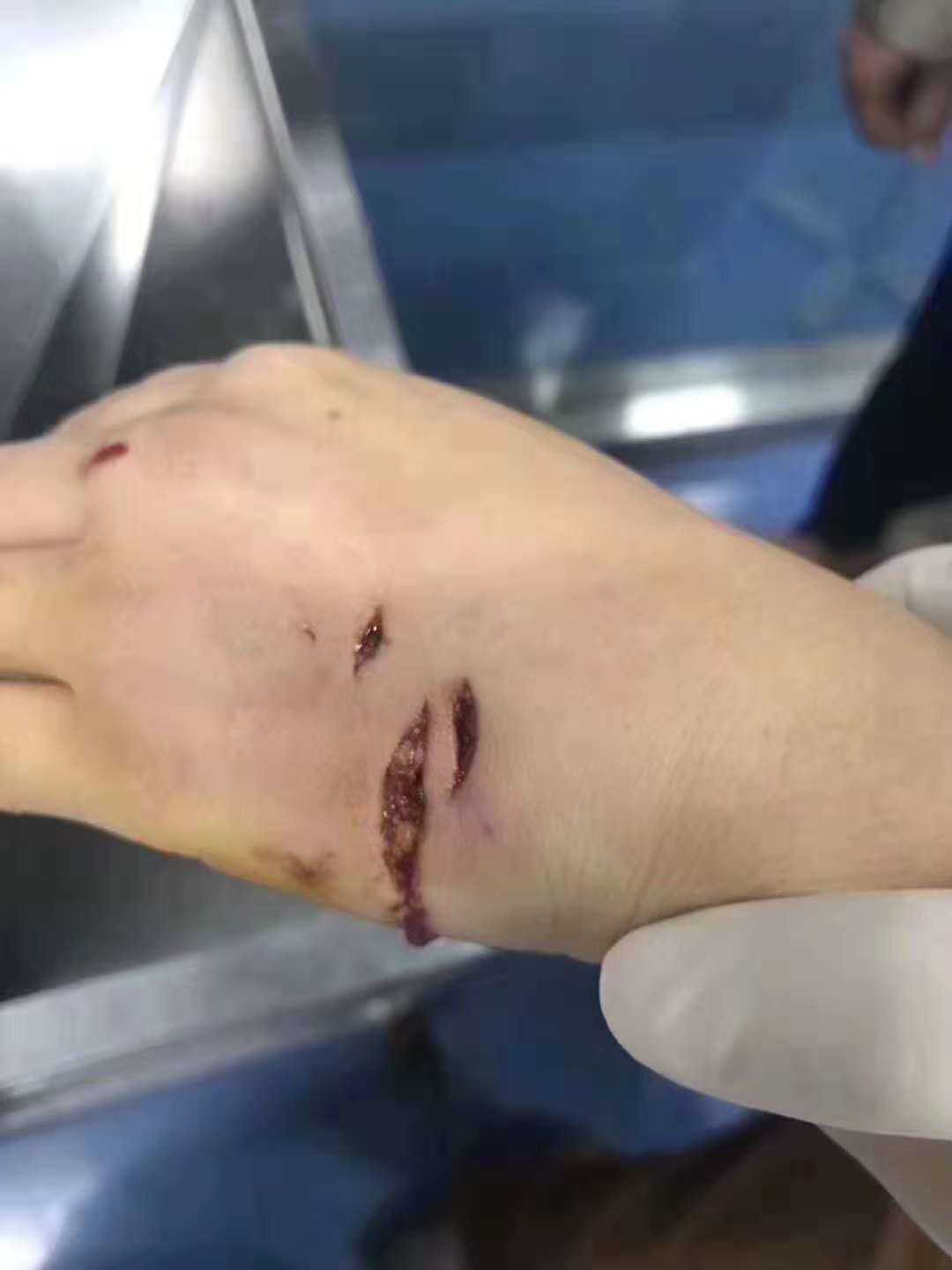 温州市区有一流浪狗流窜伤人 已经超过73人被咬伤!