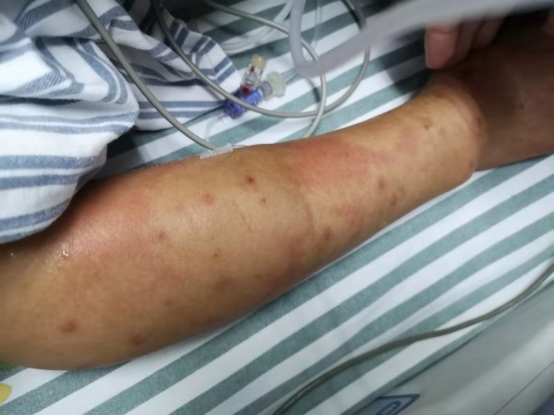 在杭州市中医院的病房里,记者见到了被马蜂咬伤的胡大伯,他的手臂上