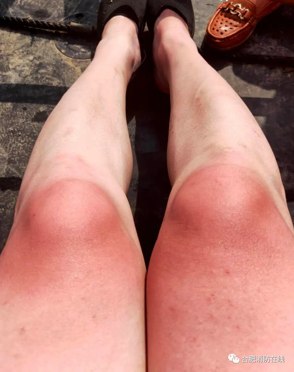 他的膝盖又红又肿 几乎不能正常弯曲和行走